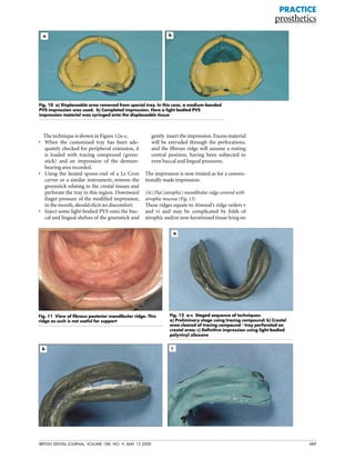 Bdj complete denture | PDF