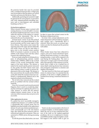 BRITISH DENTAL JOURNAL, VOLUME 188, NO. 8, APRIL 22 2000 423
the posterior border that must be provided
with a carefully formed post dam. A finger grip
may be provided so that the patient can control
insertion and removal of the device (Fig. 6).
Additionally, psychological assessment might
be appropriate for some patients, in association
with some adaptational/self-controlling mea-
sures such as auto-hypnosis and controlled
breathing (see Part 2).11,12
Occlusal pivot appliances
Where excessive freeway space is present with
existing dentures, it is not advisable to increase
the denture height beyond some 3 mm at a time
unless the tolerance of the patient to a greater
increase is first determined. This can be
achieved by the use of occlusal pivots.2
Occlusal pivots consist of two flat-surfaced
pillars of acrylic resin placed bilaterally in the
second premolar and first molar region of the
lower denture. These planes must contact the
opposing teeth of the upper denture bilaterally
and evenly. Pivots can also be used where a
gross error in the retruded contact position
(RCP) of occlusion is present, to increase the
stability of the denture bases and thus reduce
trauma to the underlying tissues.
Pivots are made using thin tin foil placed on a
paste of self-polymerising polymer (methyl
methacrylate) (PMMA) added to the occlusal
surfaces of the second premolar/first molar
region of the lower denture. The denture is
seated in the mouth and the patient instructed
to close gently into RCP. Closure must cease
when bilateral contact is made to prevent dis-
placement of the acrylic dough. The denture is
then removed from the mouth and the PMMA
cured, after which the occlusal contacts are con-
firmed as simultaneously bilateral and at the
required occlusal vertical dimension.
The tin foil is then removed and the occlusal
pivots are polished with the occlusal surfaces
made flat.
Given the increased trend towards potential
litigation, there is merit in considering adapt-
ing this technique by applying the pivots to a
‘copy’ denture, to ensure that the patient’s
original denture remains intact, in case the
outcome of this treatment does not prove to be
successful.
Other applications for pivots
If a patient has never successfully managed a
complete lower denture, or is unable to provide
a reproducible RCP, occlusal pivots may be
helpfully prescribed initially in the replacement
denture. In such cases, denture production pro-
ceeds conventionally up to the trial denture
stage, after which the lower posterior teeth are
removed and replaced by wax pivots. These are
converted to PMMA pivots during processing
(Fig. 7).
As with the pivots described earlier, care must
be taken to ensure that occlusal contact on the
flat planes is bilateral and even.
In review visits, occlusal adjustments can be
made and pressure relief provided as necessary,
until comfort and a reproducible RCP is
achieved. When this occurs, an occlusal regis-
tration can then be obtained and the posterior
teeth added.
Stents
Where border tissues have been subjected to
surgery, such as for muscle attachment reposi-
tioning, frenal tissue excision, or a sulcus deep-
ening procedure, a stent will be required to be
used during the healing phase. The stent is
made prior to surgery and is inserted immedi-
ately at the operation. If this sequence is not fol-
lowed, there is likely to be a marked loss of
sulcus depth rendering denture base extension
and consequent compromise to retention and
stability of the denture.
The stent must be of the form and required
extent of a denture base. It is essential that the
periphery of the device is highly polished, of
rounded form having a minimum thickness of
2mm.
‘Stents’ are also recommended, in the form of
a surgical template, in dental implant surgery.
When the wax try-in has confirmed the posi-
tion of the teeth on the implant-supported
prostheses, the try-in is duplicated in translu-
cent PMMA and this surgical template is modi-
fied lingual to the anterior teeth to give an
PRACTICE
prosthetics
Fig. 7 Complete
lower denture
processed in the
form of lower
pivot prosthesis
Fig. 6 Training plate
which may be used in
the treatment of a
patient with a
retching problem
 