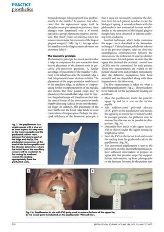 530 BRITISH DENTAL JOURNAL, VOLUME 188, NO. 10, MAY 27 2000
for facial changes following tooth loss, predom-
inantly in the maxilla.1 In essence, they advo-
cated that the replacement upper teeth be
placed in mean pre-extraction positions; these
averages were determined over a 30-month
period in a group of patients rendered edentu-
lous. The ‘fixed’ points of reference taken for
measurements were the remnants of the lingual
gingival margin (LGM) (Fig. 1). Average values
for maxillary teeth of replacement dentures are
shown on Table 1.
The biometric principle
The biometric principle has much merit in that
it helps to compensate for post-extraction bone
loss by placement of the denture teeth in per-
ceived pre-extraction positions. A further
advantage of placement of the maxillary (den-
ture) teeth labial/buccal to the residual ridge is
that this promotes lower denture stability. The
placement of the upper posterior teeth buccal
to the maxillary ridge, in addition to compen-
sating for the resorption pattern of the maxilla,
also means that their palatal cusps may be
placed over the mandibular ridge crest. In prac-
tice, the palatal cusps will therefore occlude into
the central fossae of the lower posterior teeth,
thereby directing occlusal forces onto the resid-
ual ridge. In addition, this placement of the
lower teeth over the lower ridge tends to avoid
constriction of tongue space. Perhaps the prin-
cipal deficiency of the biometric principle is
that it does not necessarily customise the den-
ture form for each patient, nor does it cater for
biological ageing. A second problem with this
philosophy is that anatomical features not dis-
similar to the remnants of the lingual gingival
margin have been observed in patients suffer-
ing from anodontia.
Another technique which helps customise
the upper rim is described in the Swissedent
technique.2 This technique, which was referred
to in the previous chapter, relies on close and
unambiguous communication between the
clinician and the technician. It uses two distinct
measurements for each patient in order that the
upper rim (termed the aesthetic control base
[ACB]) may be customised for each patient.
These two measurements are related to the
patient’s facial form and are taken immediately
after the definitive impressions have been
recorded and are dispatched along with these
impressions to the laboratory.
The first measurement is taken via what is
called the papillameter (Fig. 2). The procedures
to be followed for the papillameter reading are
as follows:
• Place the papillameter inside the patient's
upper lip and let it rest on the incisive
papilla.
• Add addition-cured polyvinyl siloxane
(PVS) putty to the papillameter and mould
the upper lip to restore the vermilion border.
In younger patients, the philtrum may be
restored but this may not be possible in older
patients (Fig. 3a).
• Determine how much of the upper incisor
will be shown under the upper resting lip
length (vide infra).
• Level the PVS at the incisal level and record
the reading from the graduated scale on the
papillameter (Fig. 3b).
• The customised papillameter is sent to the
laboratory and this enables the technician to
have sufficient information to prepare an
upper rim that provides upper lip support.
Patient information, eg from photographs
or via dentures favoured by the patient may
PRACTICE
prosthetics
Fig. 2 The papillameter is a
simple gauge with a step on
its inner aspect; this step rests
on the incisive papilla and the
graduated column rests
between the labial aspect of
the ridge and the lip. The
graduation commences at the
level of the incisive papilla and
the clinician determines where
the incisal tips of the maxillary
incisors will lie in relation to
the resting lip level and
records the reading
appropriately from the
graduated scale.
Fig. 3 a) Papillameter in situ with PVS putty used to restore the form of the upper lip;
b) The incisal point is indicated on the papillameter ‘Plimsoll-line’.
a b
 