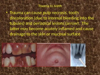 BDS_2025_Sequelae_of_Dental_caries,_resorption,_hypercementosis.pptx