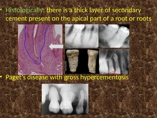Hypercementation BDS_2025_Sequelae_of_Dental_caries,_resorption,_hypercementosis.pptx