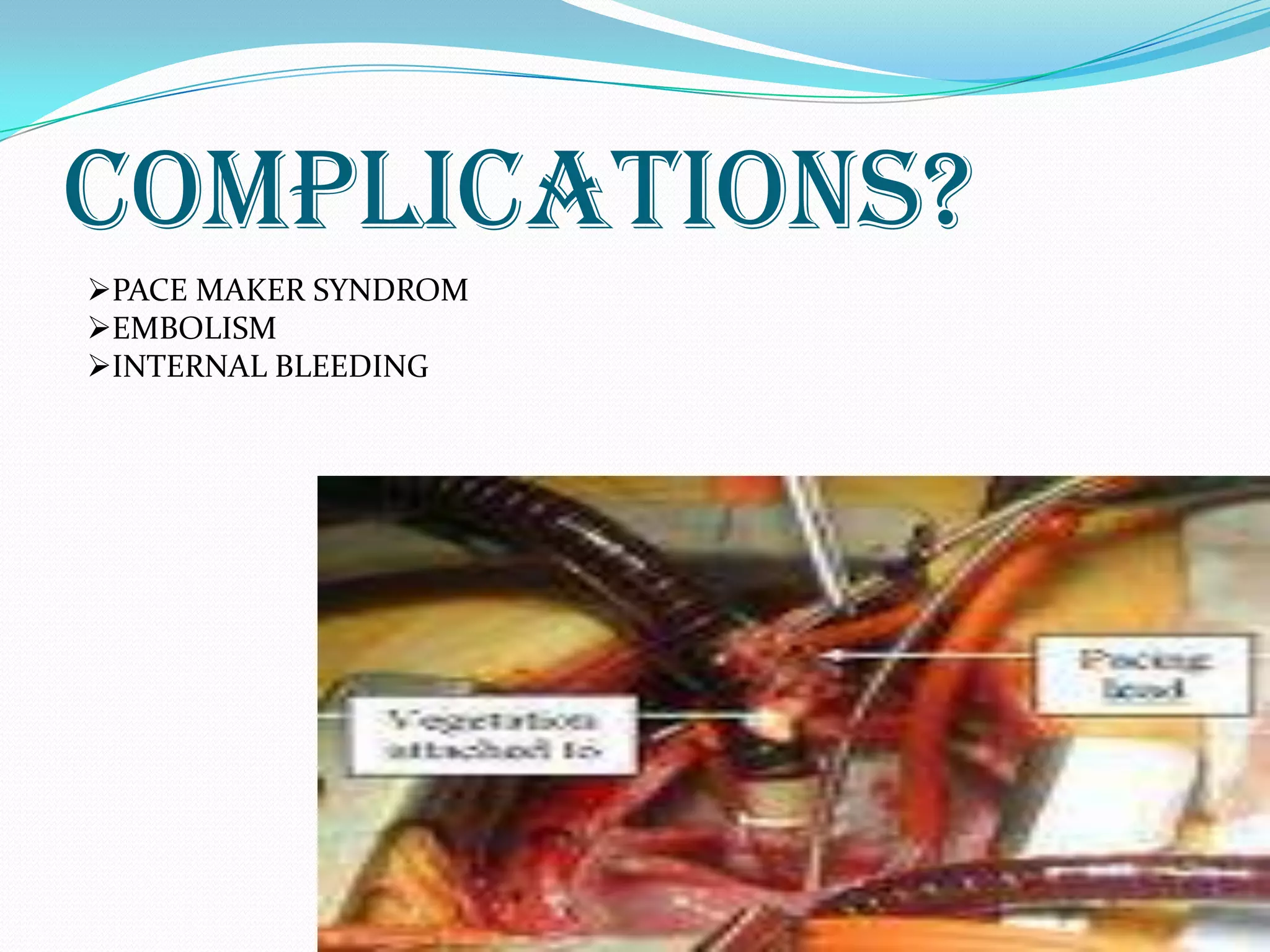 COMPLICATIONS?
PACE MAKER SYNDROM
EMBOLISM
INTERNAL BLEEDING
 