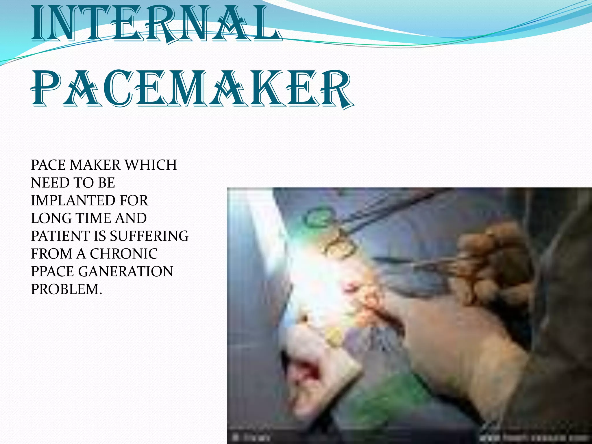 Internal
pacemaker
PACE MAKER WHICH
NEED TO BE
IMPLANTED FOR
LONG TIME AND
PATIENT IS SUFFERING
FROM A CHRONIC
PPACE GANERATION
PROBLEM.
 