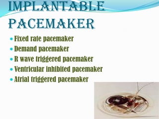 Implantable
pacemaker
 Fixed rate pacemaker
 Demand pacemaker
 R wave triggered pacemaker
 Ventricular inhibited pacemaker
 Atrial triggered pacemaker
 