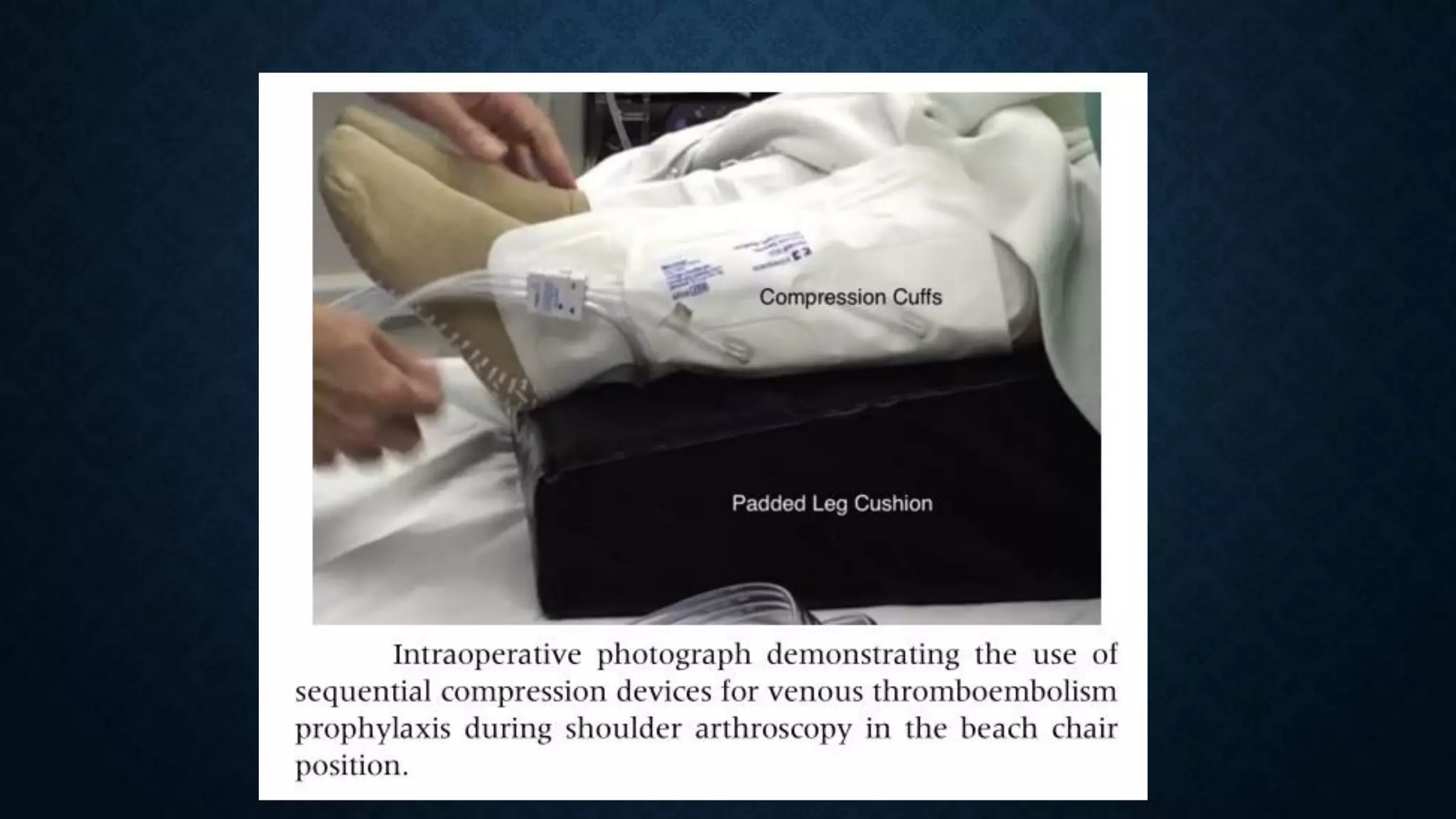 Beach chair position  a short introduction