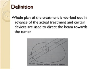 Definition Whole plan of the treatment is worked out in advance of the actual treatment and certain devices are used to direct the beam towards the tumor  