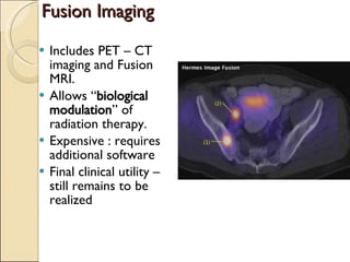 Fusion Imaging Includes PET – CT imaging and Fusion MRI. Allows “ biological modulation ” of radiation therapy. Expensive : requires additional software Final clinical utility – still remains to be realized 