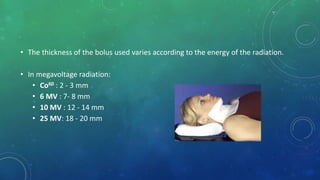 • The thickness of the bolus used varies according to the energy of the radiation.
• In megavoltage radiation:
• Co60 : 2 - 3 mm
• 6 MV : 7- 8 mm
• 10 MV : 12 - 14 mm
• 25 MV: 18 - 20 mm
 