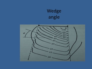 Wedge
angle
 
