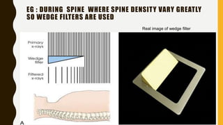EG : DURING SPINE WHERE SPINE DENSITY VARY GREATLY
SO WEDGE FILTERS ARE USED
Real image of wedge filter
 