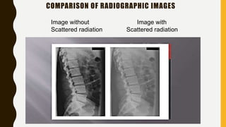 COMPARISON OF RADIOGRAPHIC IMAGES
Image without Image with
Scattered radiation Scattered radiation
 