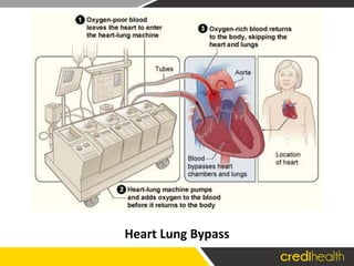 Heart Lung Bypass
 