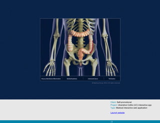 Client: Self-promotional
Project: Ulcerative Colitis (UC) interactive app
Type: Medical interactive web application

Launch website



23
 