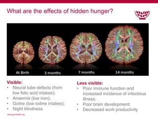 www.gainhealth.org
What are the effects of hidden hunger?
Visible:
• Neural tube defects (from
low folic acid intakes);
• ...
