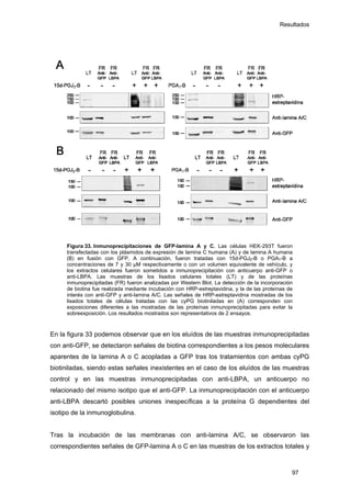 Resultados
Figura 33. Inmunoprecipitaciones de GFP-lamina A y C. Las células HEK-293T fueron
transfectadas con los plásmidos de expresión de lamina C humana (A) y de lamina A humana
(B) en fusión con GFP. A continuación, fueron tratadas con 15d-PGJ2-B o PGA1-B a
concentraciones de 7 y 30 µM respectivamente o con un volumen equivalente de vehículo, y
los extractos celulares fueron sometidos a inmunoprecipitación con anticuerpo anti-GFP o
anti-LBPA. Las muestras de los lisados celulares totales (LT) y de las proteínas
inmunoprecipitadas (FR) fueron analizadas por Western Blot. La detección de la incorporación
de biotina fue realizada mediante incubación con HRP-estreptavidina, y la de las proteínas de
interés con anti-GFP y anti-lamina A/C. Las señales de HRP-estreptavidina mostradas de los
lisados totales de células tratadas con las cyPG biotiniladas en (A) corresponden con
exposiciones diferentes a las mostradas de las proteínas inmunoprecipitadas para evitar la
sobreexposición. Los resultados mostrados son representativos de 2 ensayos.
En la figura 33 podemos observar que en los eluídos de las muestras inmunoprecipitadas
con anti-GFP, se detectaron señales de biotina correspondientes a los pesos moleculares
aparentes de la lamina A o C acopladas a GFP tras los tratamientos con ambas cyPG
biotiniladas, siendo estas señales inexistentes en el caso de los eluídos de las muestras
control y en las muestras inmunoprecipitadas con anti-LBPA, un anticuerpo no
relacionado del mismo isotipo que el anti-GFP. La inmunoprecipitación con el anticuerpo
anti-LBPA descartó posibles uniones inespecíficas a la proteína G dependientes del
isotipo de la inmunoglobulina.
Tras la incubación de las membranas con anti-lamina A/C, se observaron las
correspondientes señales de GFP-lamina A o C en las muestras de los extractos totales y
97
 