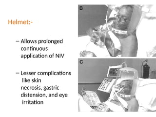 Helmet:-
– Allows prolonged
continuous
application of NIV
– Lesser complications
like skin
necrosis, gastric
distension, and eye
irritation
 