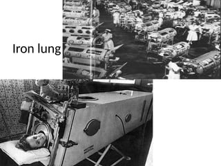 Iron lung
 