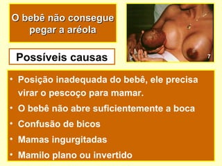 O bebê não consegue
   pegar a aréola

 Possíveis causas                           7



• Posição inadequada do bebê, ele precisa
  virar o pescoço para mamar.
• O bebê não abre suficientemente a boca
• Confusão de bicos
• Mamas ingurgitadas
• Mamilo plano ou invertido
 