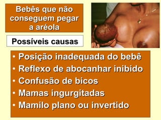 Bebês que não conseguem pegar a aréola Posição inadequada do bebê Reflexo de abocanhar inibido Confusão de bicos Mamas ingurgitadas Mamilo plano ou invertido Possíveis causas 
