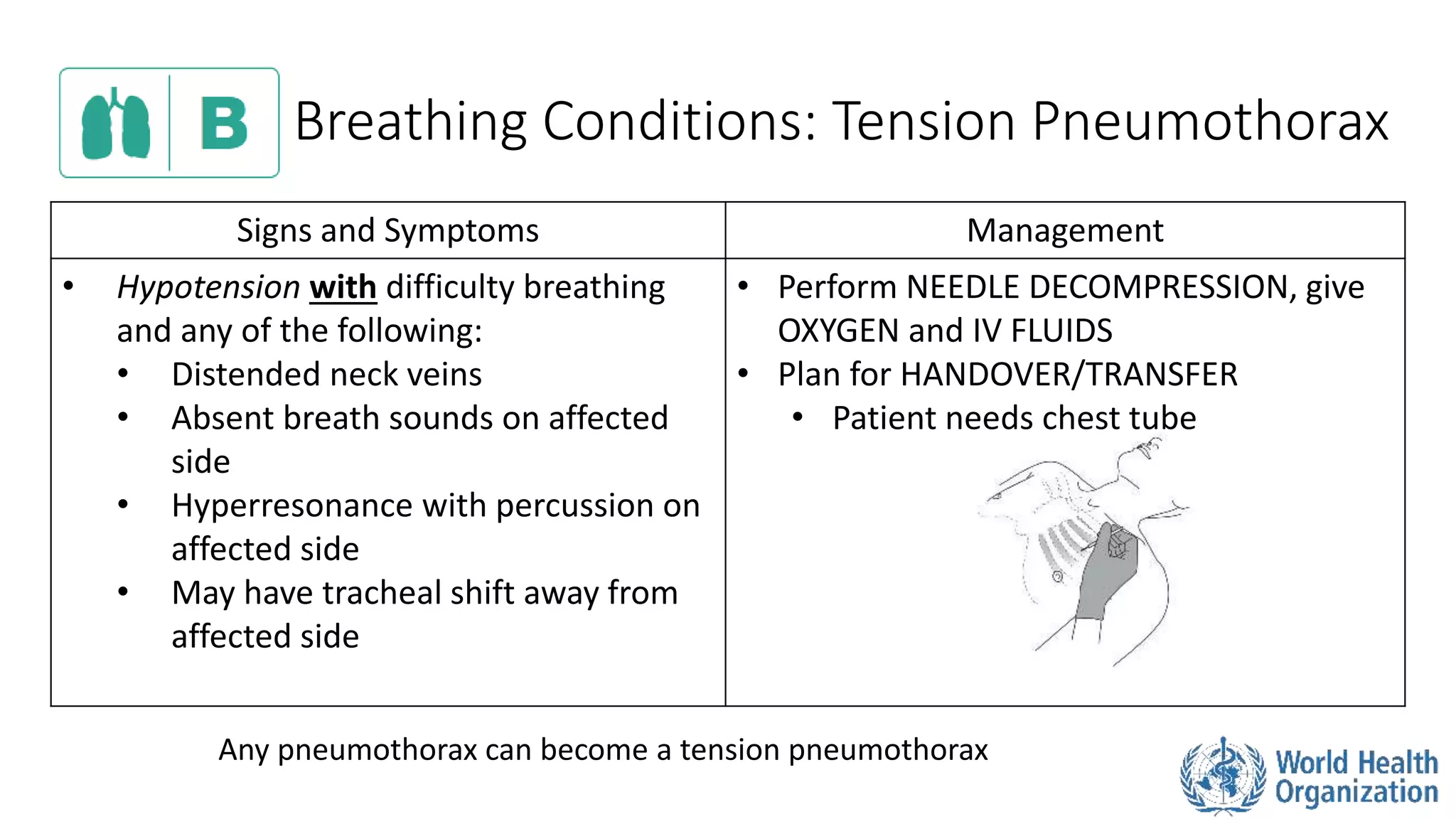 Breathing Conditions: Tension Pneumothorax
Signs and Symptoms Management
• Hypotension with difficulty breathing
and any of the following:
• Distended neck veins
• Absent breath sounds on affected
side
• Hyperresonance with percussion on
affected side
• May have tracheal shift away from
affected side
• Perform NEEDLE DECOMPRESSION, give
OXYGEN and IV FLUIDS
• Plan for HANDOVER/TRANSFER
• Patient needs chest tube
Any pneumothorax can become a tension pneumothorax
 