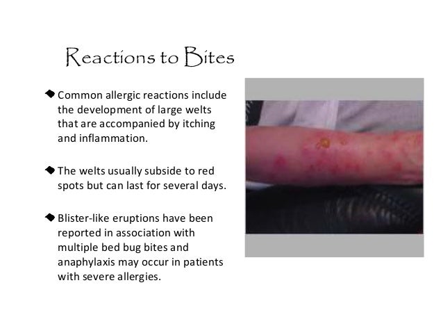Cdc Bed Bugs In Schools Cdc Bed Bugs In Schools