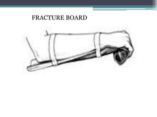 FRACTURE BOARD
 