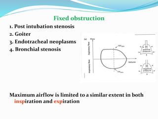 Fixed obstruction
1. Post intubation stenosis
2. Goiter
3. Endotracheal neoplasms
4. Bronchial stenosis
Maximum airflow is limited to a similar extent in both
inspiration and expiration
 
