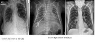 Correct placement of NG tube
Incorrect placement of NG tube
 