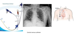Central venous catheter
 