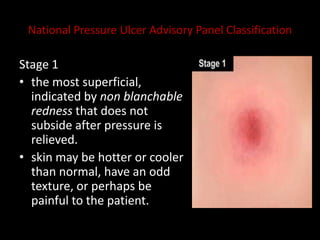 National Pressure Ulcer Advisory Panel Classification
Stage 1
• the most superficial,
indicated by non blanchable
redness that does not
subside after pressure is
relieved.
• skin may be hotter or cooler
than normal, have an odd
texture, or perhaps be
painful to the patient.
 