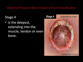 National Pressure Ulcer Advisory Panel Classification
Stage 4
• is the deepest,
extending into the
muscle, tendon or even
bone.
 
