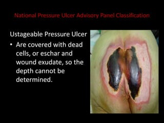 National Pressure Ulcer Advisory Panel Classification
Ustageable Pressure Ulcer
• Are covered with dead
cells, or eschar and
wound exudate, so the
depth cannot be
determined.
 