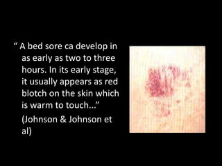 “ A bed sore ca develop in
as early as two to three
hours. In its early stage,
it usually appears as red
blotch on the skin which
is warm to touch...”
(Johnson & Johnson et
al)
 