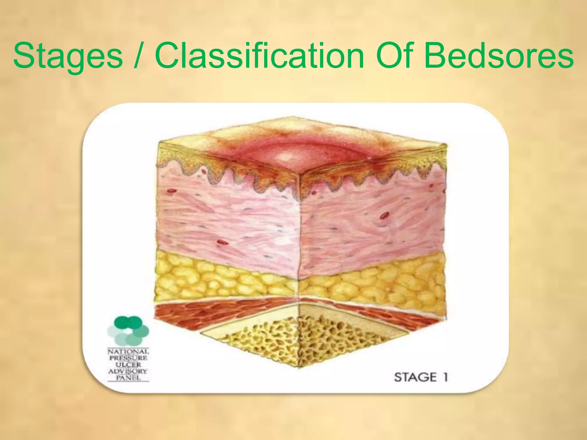 Bed sores / decubitis ulcer / pressure sores PPT