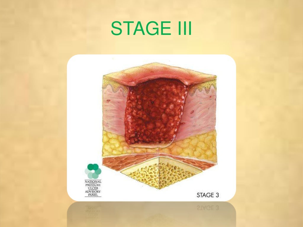 Bed sores / decubitis ulcer / pressure sores
