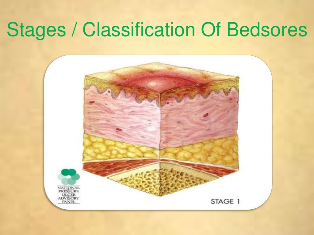 Bed sores / decubitis ulcer / pressure sores
