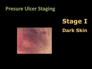 Presure Ulcer Staging

                        Stage I
                        Dark Skin
 