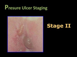 Presure Ulcer Staging

                    Stage II
 