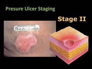 Presure Ulcer Staging
                        Stage II
 
