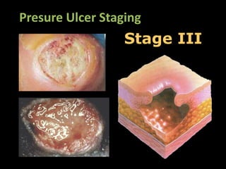 Presure Ulcer Staging
                  Stage III
 