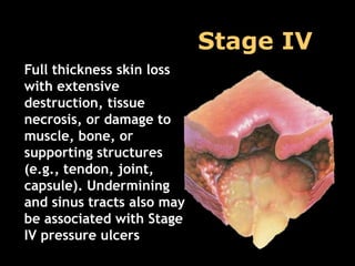 Pressure Ulcer Staging
                    Stage IV
Full thickness skin loss
with extensive
destruction, tissue
necrosis, or damage to
muscle, bone, or
supporting structures
(e.g., tendon, joint,
capsule). Undermining
and sinus tracts also may
be associated with Stage
IV pressure ulcers
 
