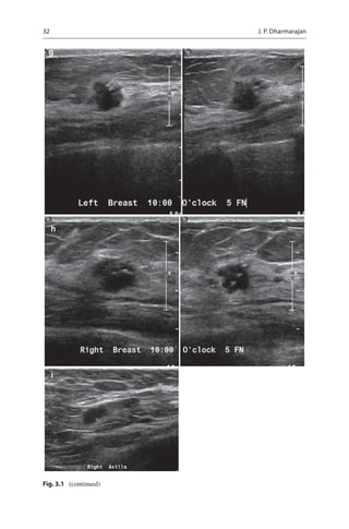 Management of Early Stage Breast Cancer | PDF