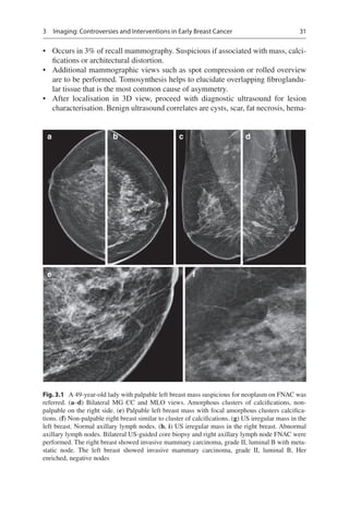 31
Fig. 3.1 A 49-year-old lady with palpable left breast mass suspicious for neoplasm on FNAC was
referred. (a–d) Bilatera...