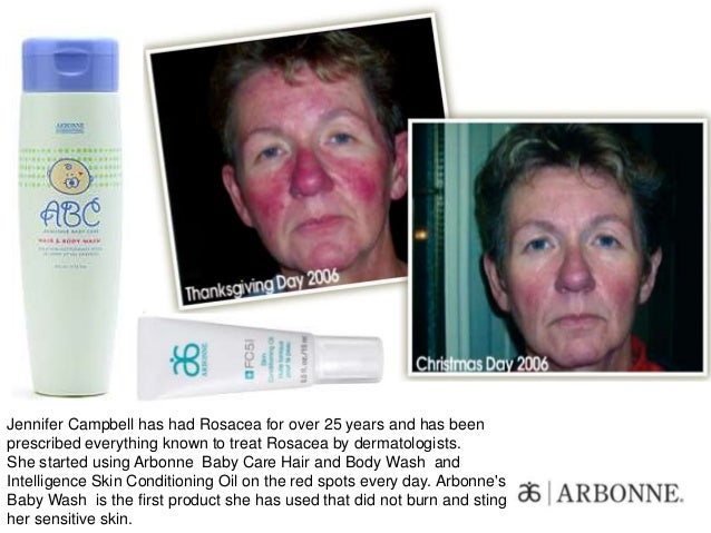 arbonne rosacea