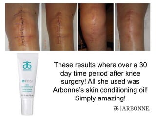 These results where over a 30
day time period after knee
surgery! All she used was
Arbonne’s skin conditioning oil!
Simply amazing!
 