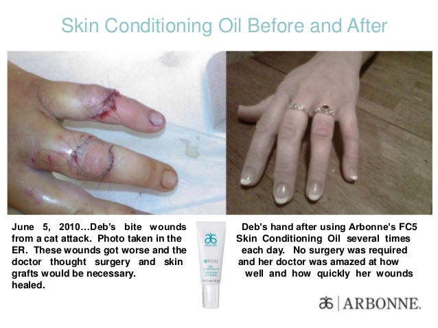 arbonne eczema cream