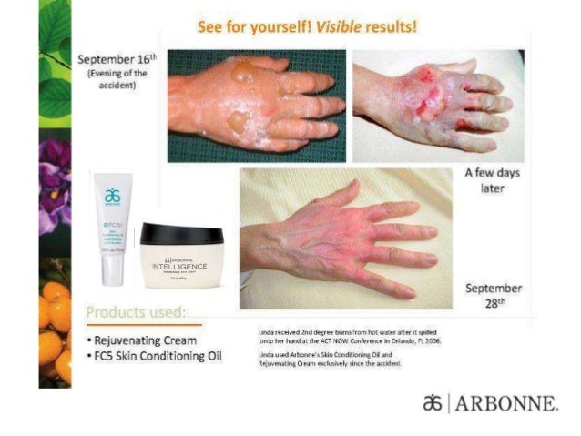 arbonne rosacea