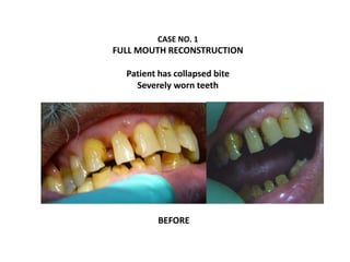 CASE NO. 1
FULL MOUTH RECONSTRUCTION
Patient has collapsed bite
Severely worn teeth
BEFORE
 