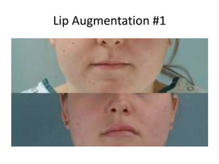 Lip Augmentation #1
 