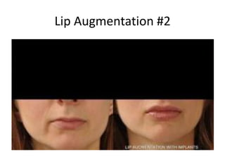 Lip Augmentation #2
 